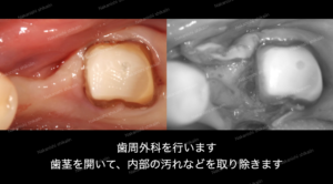 歯周病　歯周外科治療で歯茎をめくり、内側の汚れを取ります